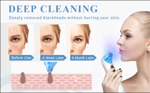 4 in 1 High-Quality Blackhead Removal Machine